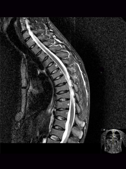 Sagittal T2-weighted images demonstrating multilevel vertebral compression fractures